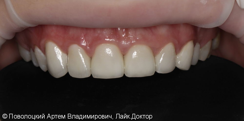 Керамические виниры E-max на переднюю группу зубов верхней челюсти - фото №6