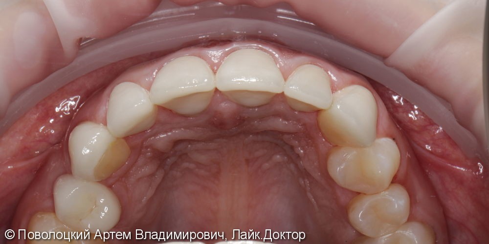 Керамические виниры E-max на переднюю группу зубов верхней челюсти - фото №7