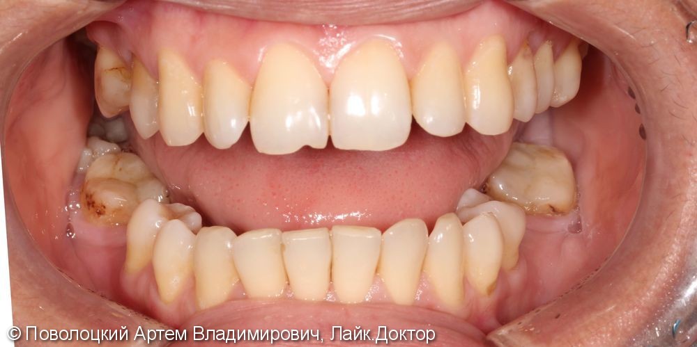 Протезирование на имплантатах Osstem 36, 46 зубы, коронки металлокерамические на своих зубах 37, 47 - фото №2