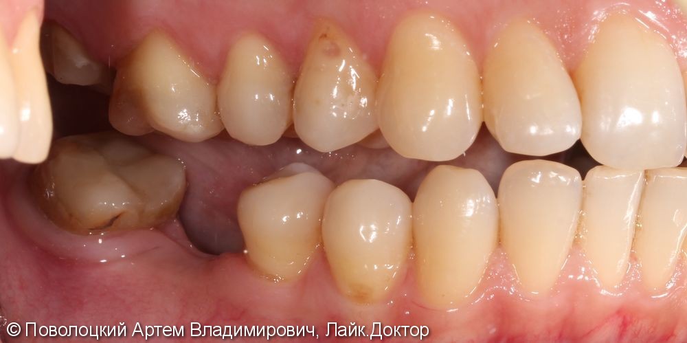 Протезирование на имплантатах Osstem 36, 46 зубы, коронки металлокерамические на своих зубах 37, 47 - фото №3