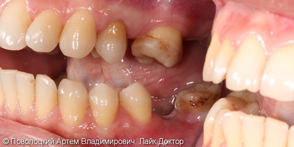 Протезирование на имплантатах Osstem 36, 46 зубы, коронки металлокерамические на своих зубах 37, 47 - фото №4