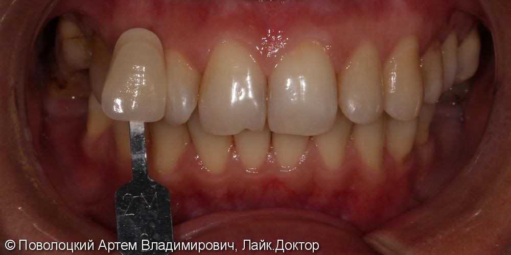 Протезирование на имплантатах Osstem 36, 46 зубы, коронки металлокерамические на своих зубах 37, 47 - фото №5