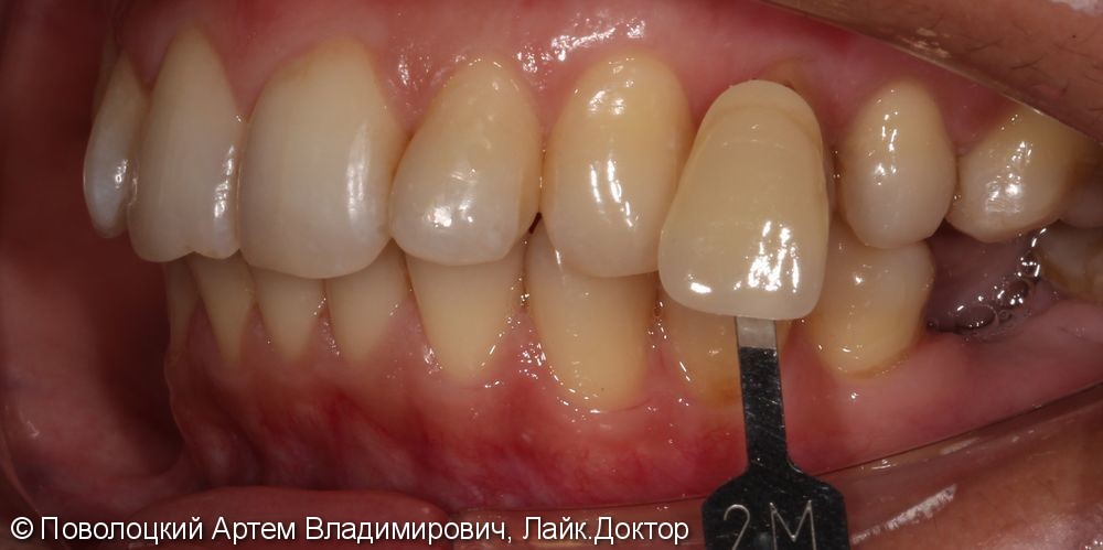 Протезирование на имплантатах Osstem 36, 46 зубы, коронки металлокерамические на своих зубах 37, 47 - фото №6