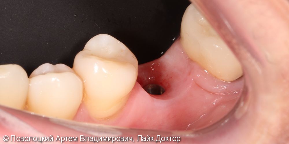 Протезирование на имплантатах Osstem 36, 46 зубы, коронки металлокерамические на своих зубах 37, 47 - фото №7