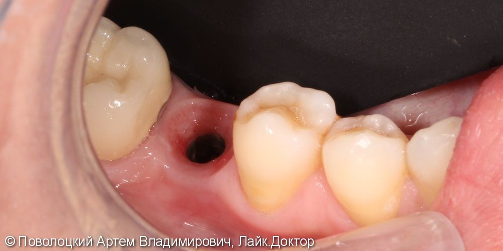 Протезирование на имплантатах Osstem 36, 46 зубы, коронки металлокерамические на своих зубах 37, 47 - фото №8