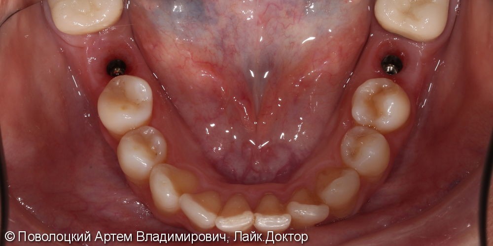 Протезирование на имплантатах Osstem 36, 46 зубы, коронки металлокерамические на своих зубах 37, 47 - фото №9
