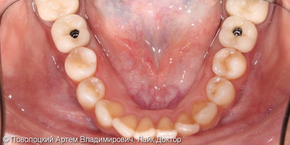 Протезирование на имплантатах Osstem 36, 46 зубы, коронки металлокерамические на своих зубах 37, 47 - фото №10