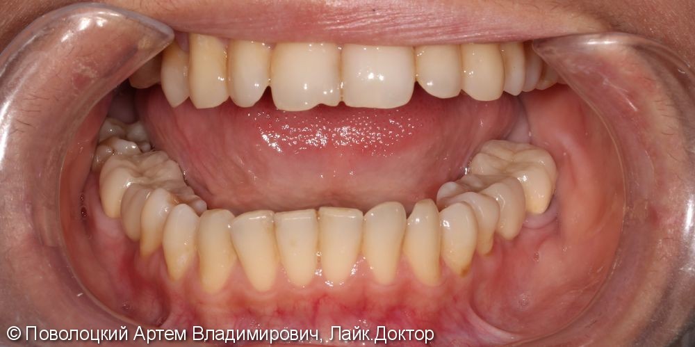 Протезирование на имплантатах Osstem 36, 46 зубы, коронки металлокерамические на своих зубах 37, 47 - фото №11