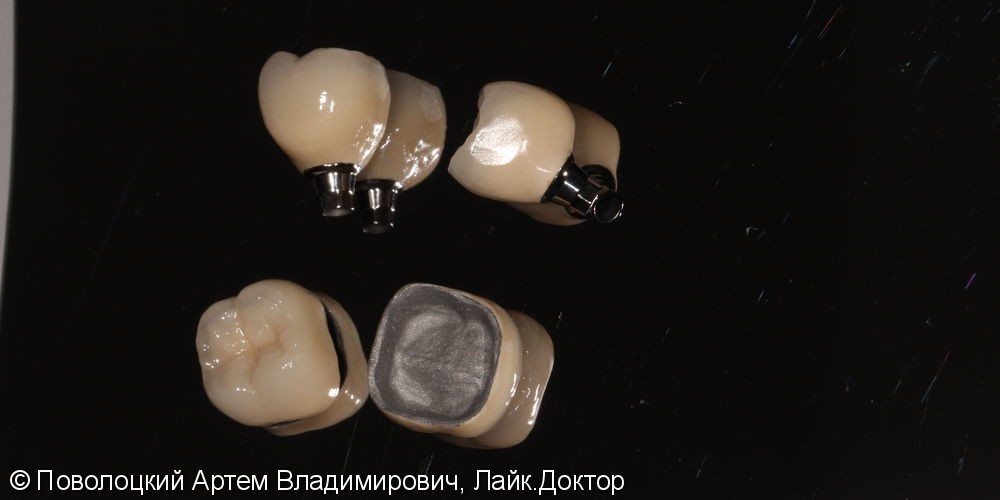 Протезирование на имплантатах Osstem 36, 46 зубы, коронки металлокерамические на своих зубах 37, 47 - фото №12