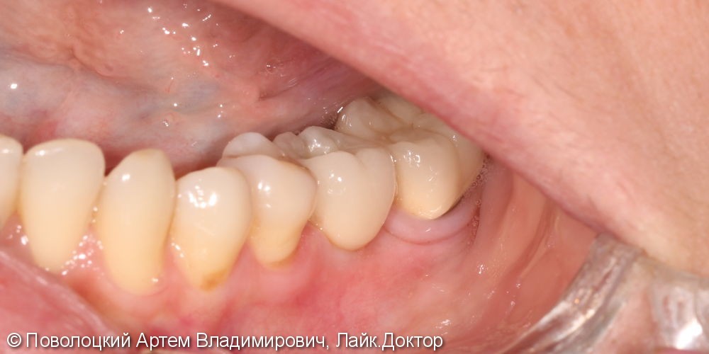 Протезирование на имплантатах Osstem 36, 46 зубы, коронки металлокерамические на своих зубах 37, 47 - фото №13
