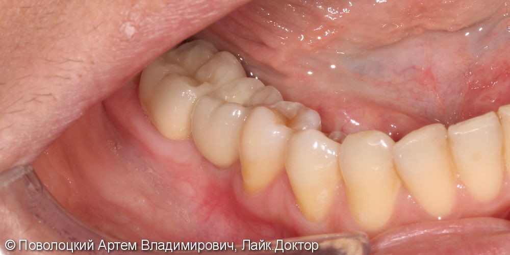 Протезирование на имплантатах Osstem 36, 46 зубы, коронки металлокерамические на своих зубах 37, 47 - фото №14
