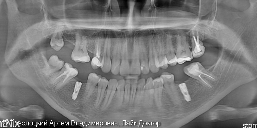 Протезирование на имплантатах Osstem 36, 46 зубы, коронки металлокерамические на своих зубах 37, 47 - фото №15