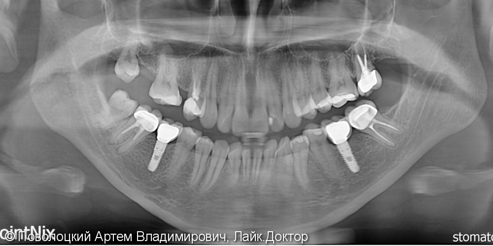 Протезирование на имплантатах Osstem 36, 46 зубы, коронки металлокерамические на своих зубах 37, 47 - фото №16