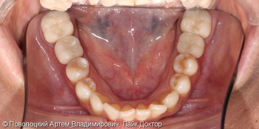 Протезирование на имплантатах Osstem 36, 46 зубы, коронки металлокерамические на своих зубах 37, 47 - фото №18