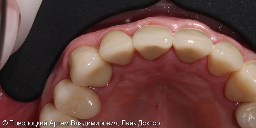 Покрытие бокового резца верхней челюсти безметалловой коронкой E-max - фото №5