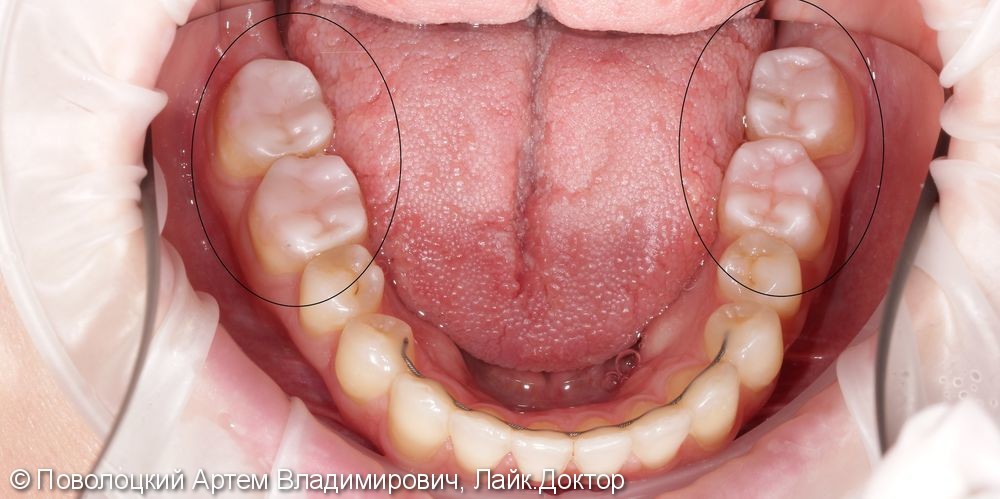 Керамические накладки на жевательные зубы нижней челюсти - фото №1