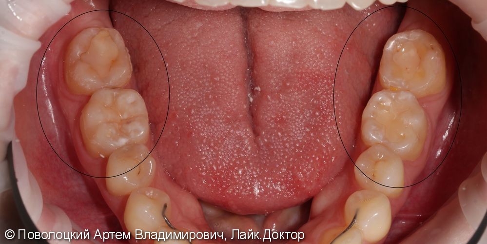 Керамические накладки на жевательные зубы нижней челюсти - фото №2