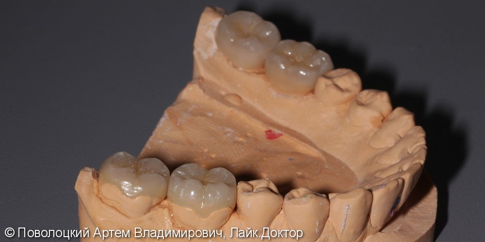 Керамические накладки на жевательные зубы нижней челюсти - фото №5