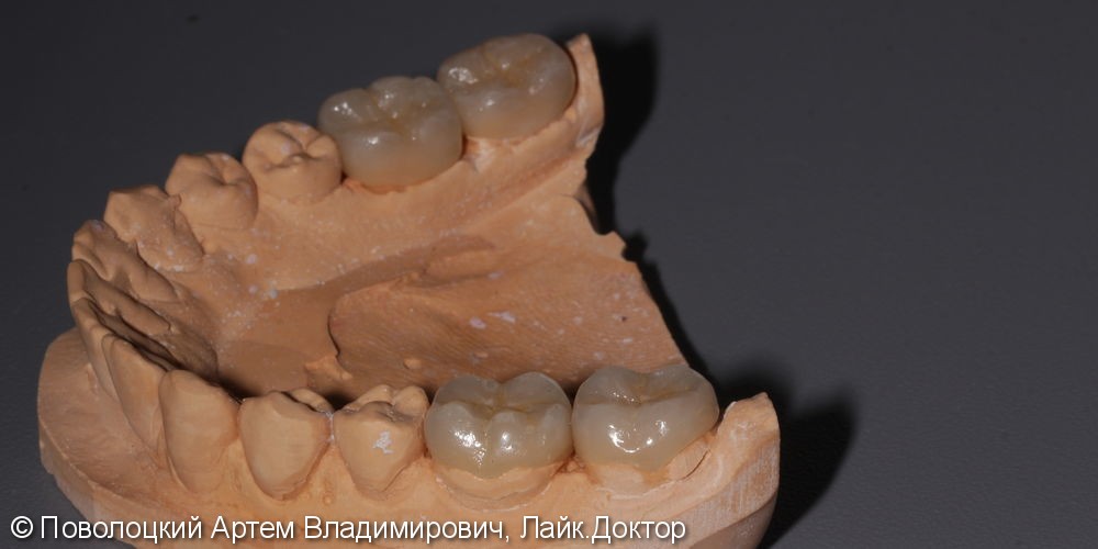 Керамические накладки на жевательные зубы нижней челюсти - фото №6