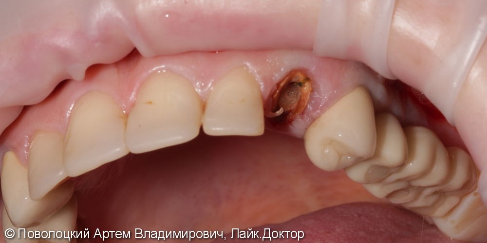 Одномоментная имплантация 23 зуба, до и после - фото №1