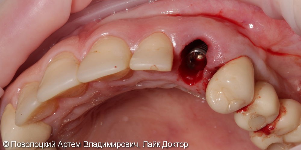 Одномоментная имплантация 23 зуба, до и после - фото №8