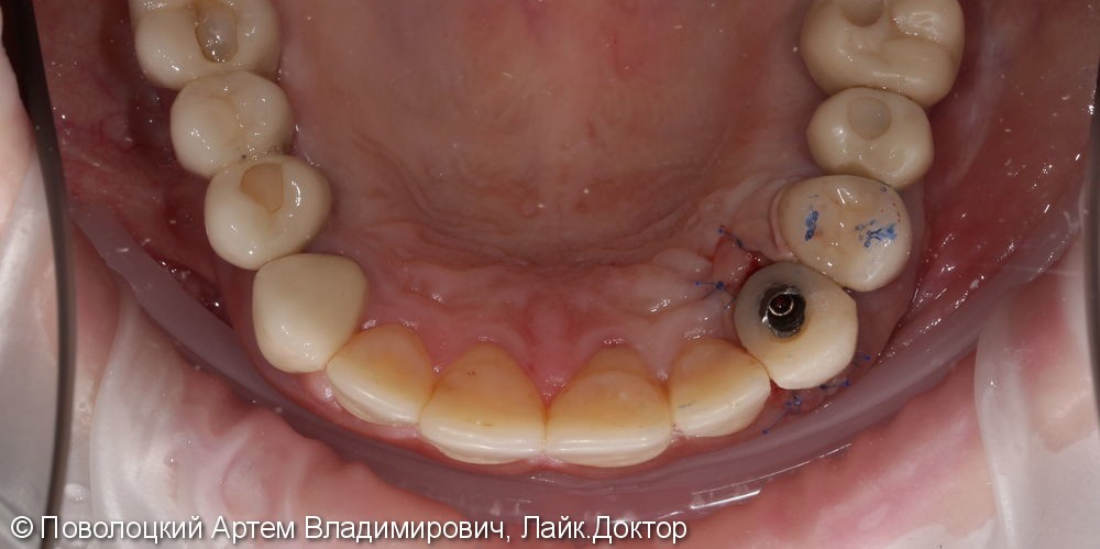 Одномоментная имплантация 23 зуба, до и после - фото №12
