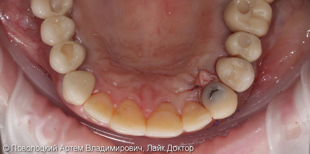 Одномоментная имплантация 23 зуба, до и после - фото №13
