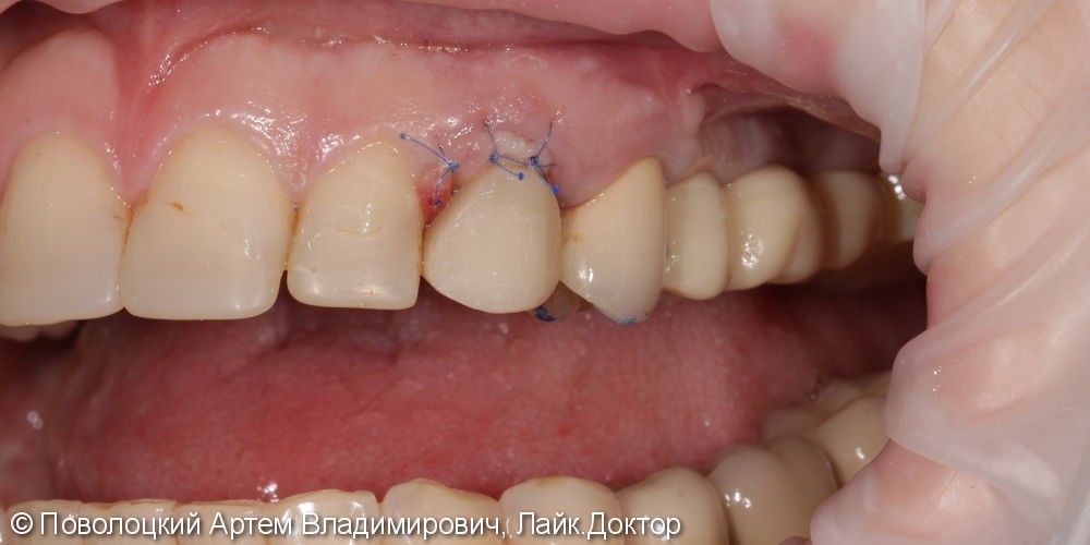 Одномоментная имплантация 23 зуба, до и после - фото №14