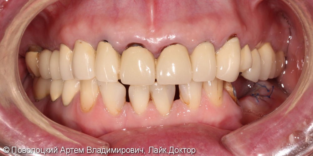 Имплантация жевательных зубов и протезирование коронками из диоксида циркония облицованные керамикой - фото №1