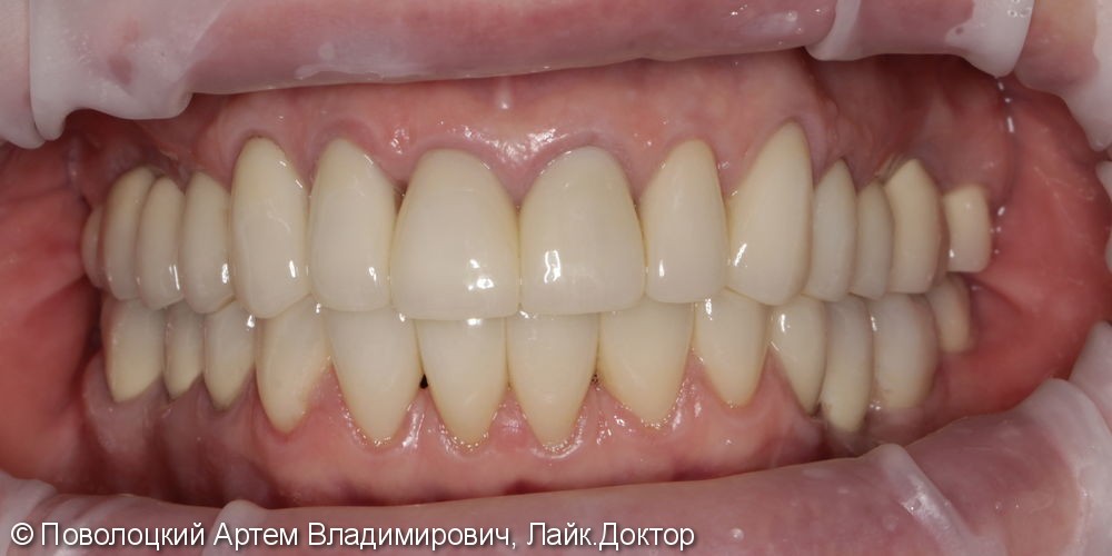 Имплантация жевательных зубов и протезирование коронками из диоксида циркония облицованные керамикой - фото №36