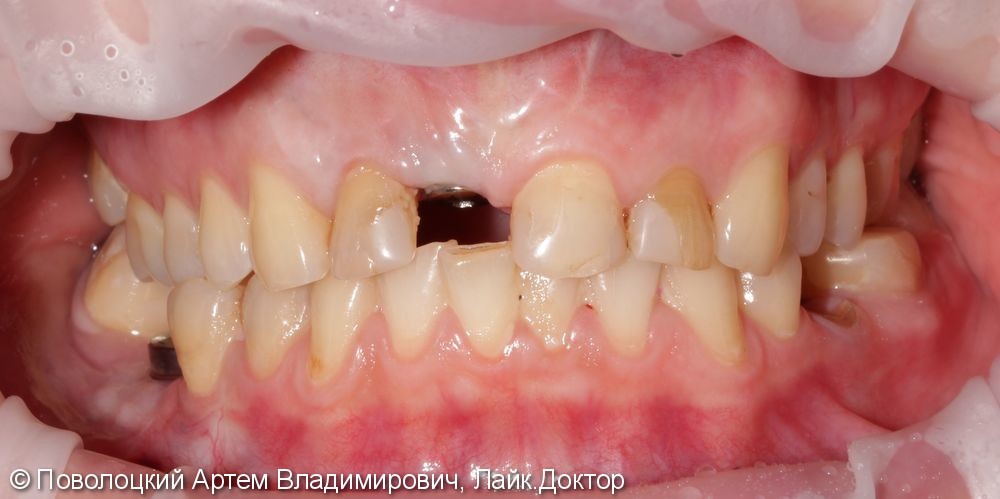 Костная пластика в обл. 46,11 зубов с имплантацией система Osstem, протезирование на имплантатах и коронки E-max на резцы в-ч. - фото №1