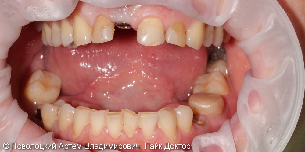 Костная пластика в обл. 46,11 зубов с имплантацией система Osstem, протезирование на имплантатах и коронки E-max на резцы в-ч. - фото №2