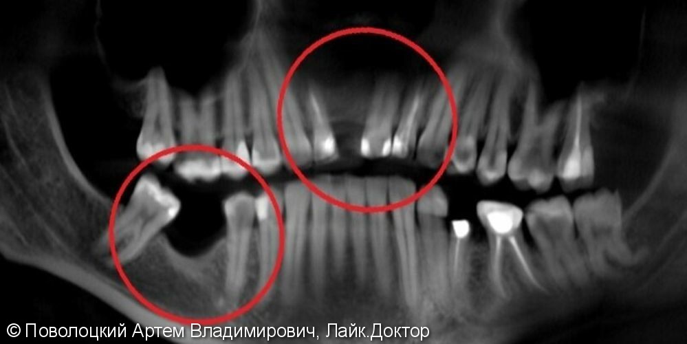 Костная пластика в обл. 46,11 зубов с имплантацией система Osstem, протезирование на имплантатах и коронки E-max на резцы в-ч. - фото №3