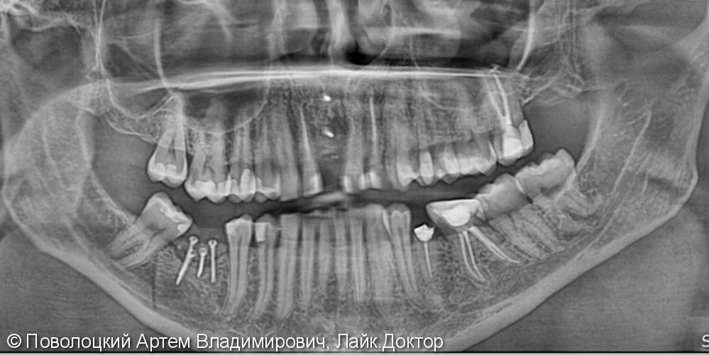 Костная пластика в обл. 46,11 зубов с имплантацией система Osstem, протезирование на имплантатах и коронки E-max на резцы в-ч. - фото №4