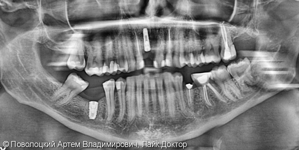 Костная пластика в обл. 46,11 зубов с имплантацией система Osstem, протезирование на имплантатах и коронки E-max на резцы в-ч. - фото №5