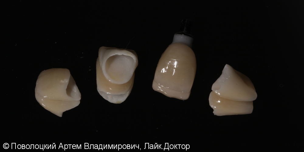 Костная пластика в обл. 46,11 зубов с имплантацией система Osstem, протезирование на имплантатах и коронки E-max на резцы в-ч. - фото №6