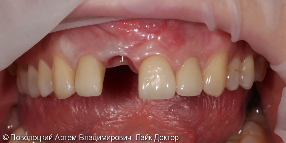Костная пластика в обл. 46,11 зубов с имплантацией система Osstem, протезирование на имплантатах и коронки E-max на резцы в-ч. - фото №7