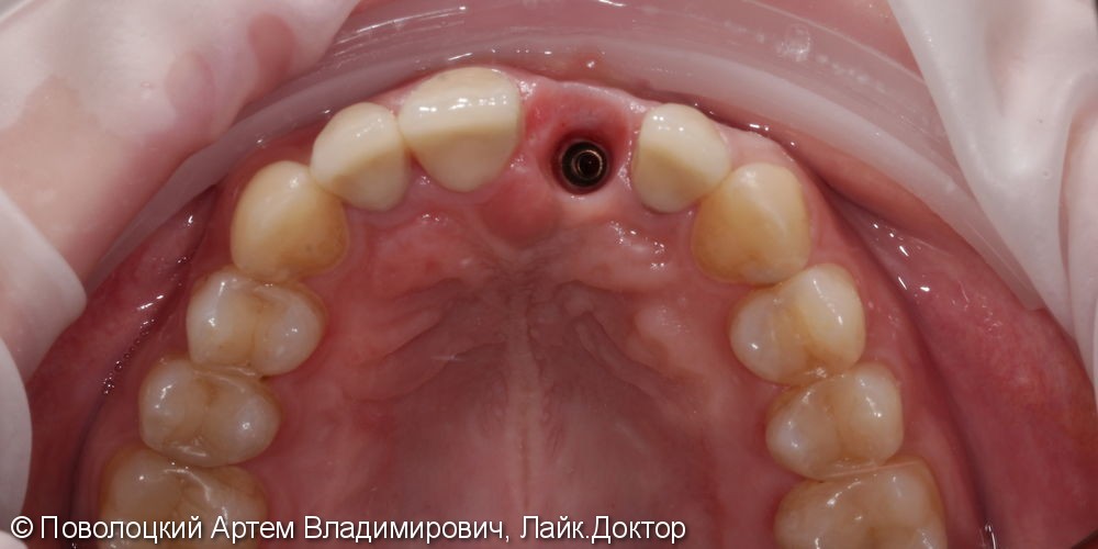 Костная пластика в обл. 46,11 зубов с имплантацией система Osstem, протезирование на имплантатах и коронки E-max на резцы в-ч. - фото №8