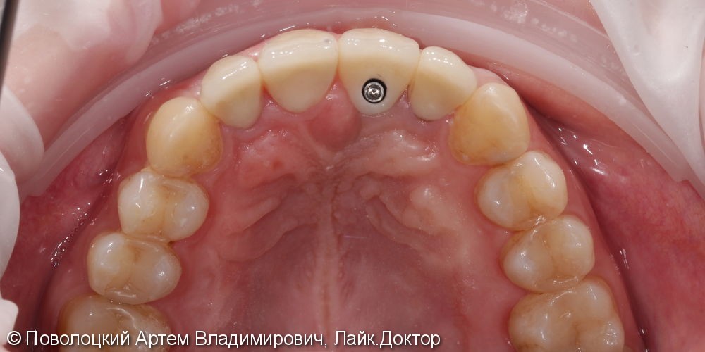 Костная пластика в обл. 46,11 зубов с имплантацией система Osstem, протезирование на имплантатах и коронки E-max на резцы в-ч. - фото №9