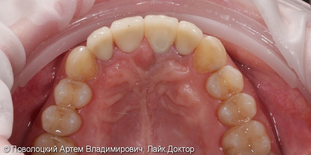 Костная пластика в обл. 46,11 зубов с имплантацией система Osstem, протезирование на имплантатах и коронки E-max на резцы в-ч. - фото №10