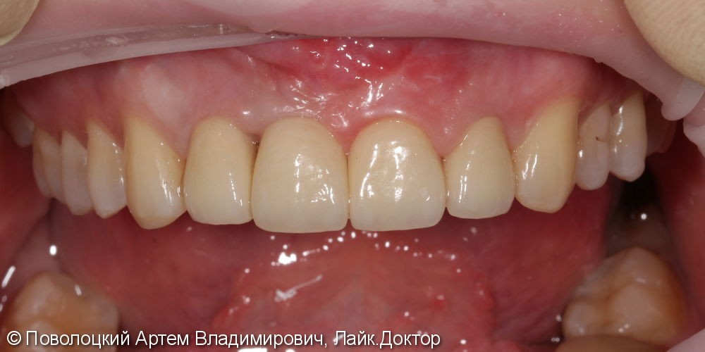 Костная пластика в обл. 46,11 зубов с имплантацией система Osstem, протезирование на имплантатах и коронки E-max на резцы в-ч. - фото №11