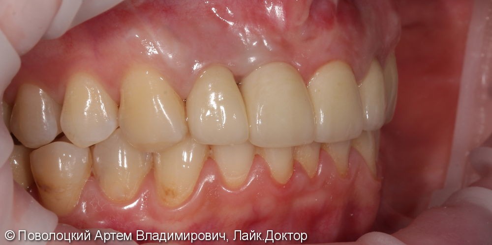 Костная пластика в обл. 46,11 зубов с имплантацией система Osstem, протезирование на имплантатах и коронки E-max на резцы в-ч. - фото №13