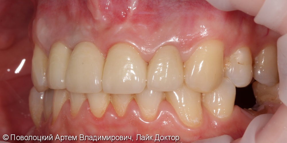 Костная пластика в обл. 46,11 зубов с имплантацией система Osstem, протезирование на имплантатах и коронки E-max на резцы в-ч. - фото №14