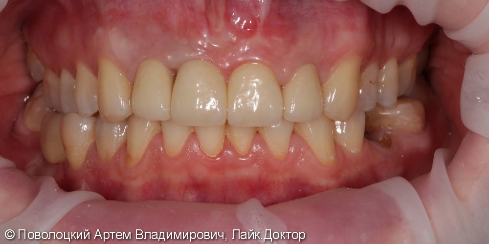 Костная пластика в обл. 46,11 зубов с имплантацией система Osstem, протезирование на имплантатах и коронки E-max на резцы в-ч. - фото №16
