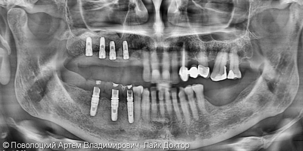 Протезирование жевательной группы зубов справа на имплантатах Osstem, коронки из диоксида циркония - фото №1