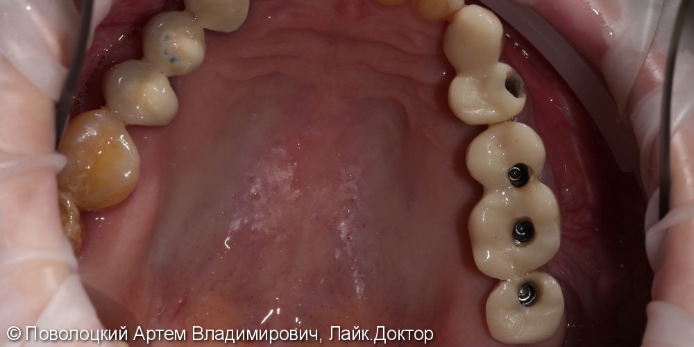 Протезирование жевательной группы зубов справа на имплантатах Osstem, коронки из диоксида циркония - фото №3