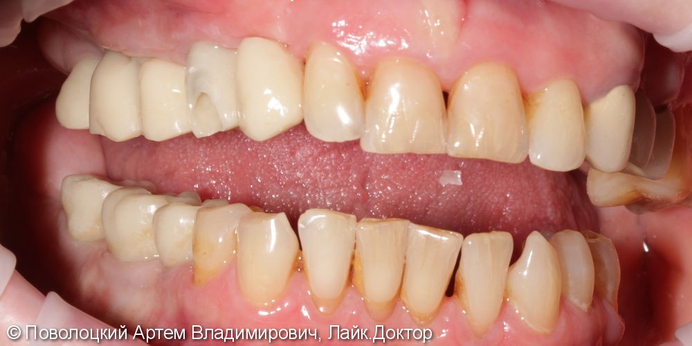 Протезирование жевательной группы зубов справа на имплантатах Osstem, коронки из диоксида циркония - фото №4