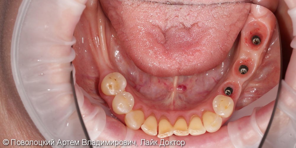 Протезирование жевательной группы зубов справа на имплантатах Osstem, коронки из диоксида циркония - фото №5