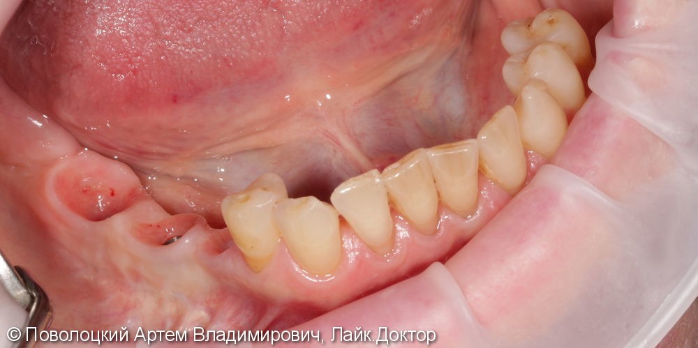 Протезирование жевательной группы зубов справа на имплантатах Osstem, коронки из диоксида циркония - фото №6