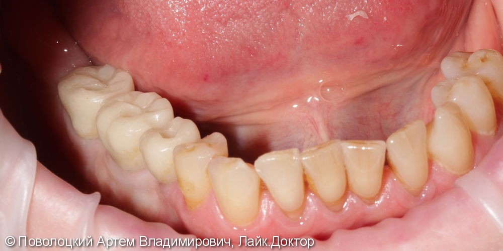 Протезирование жевательной группы зубов справа на имплантатах Osstem, коронки из диоксида циркония - фото №7
